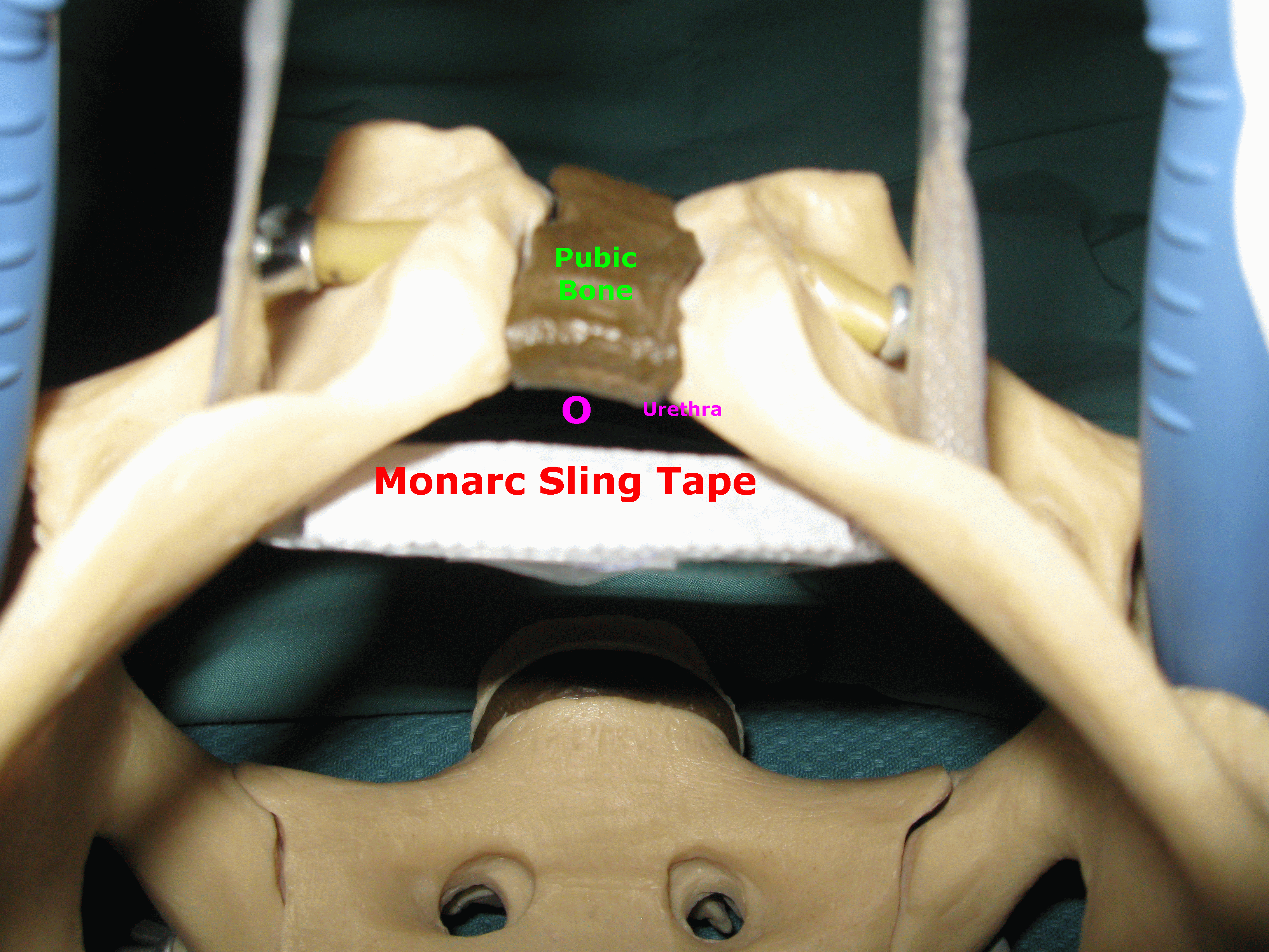 Monarc Sling Tape in Obturator Foramen Serag Youssif1